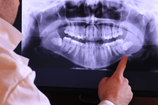 Best Emergency Wisdom Tooth Extraction in Five Points, NC